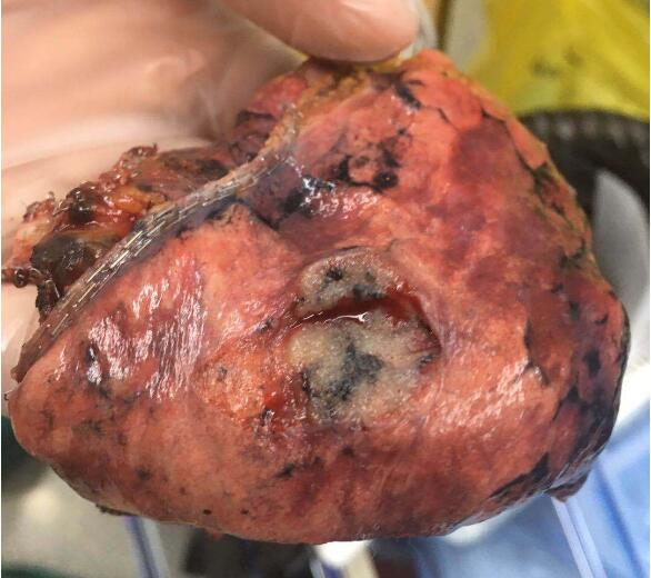 来自8mm磨玻璃结节患者的感谢信