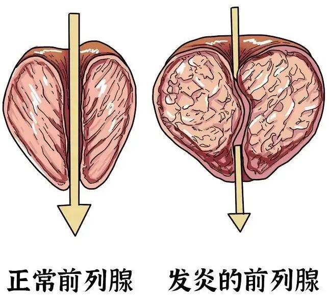 前列腺炎的保养