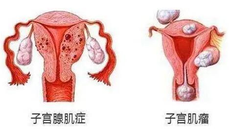 子宫腺肌症、子宫肌瘤的病症表现有哪