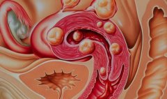 子宫肌瘤怎么治？药物治疗可以吗？