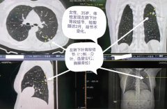 体检很多人肺都有结节，中医对肺结节