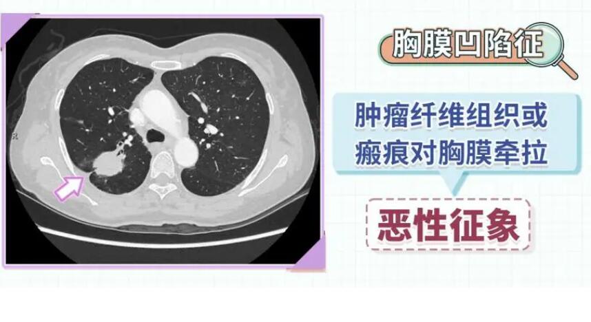 发现肺结节，如何判断结节的位置和良